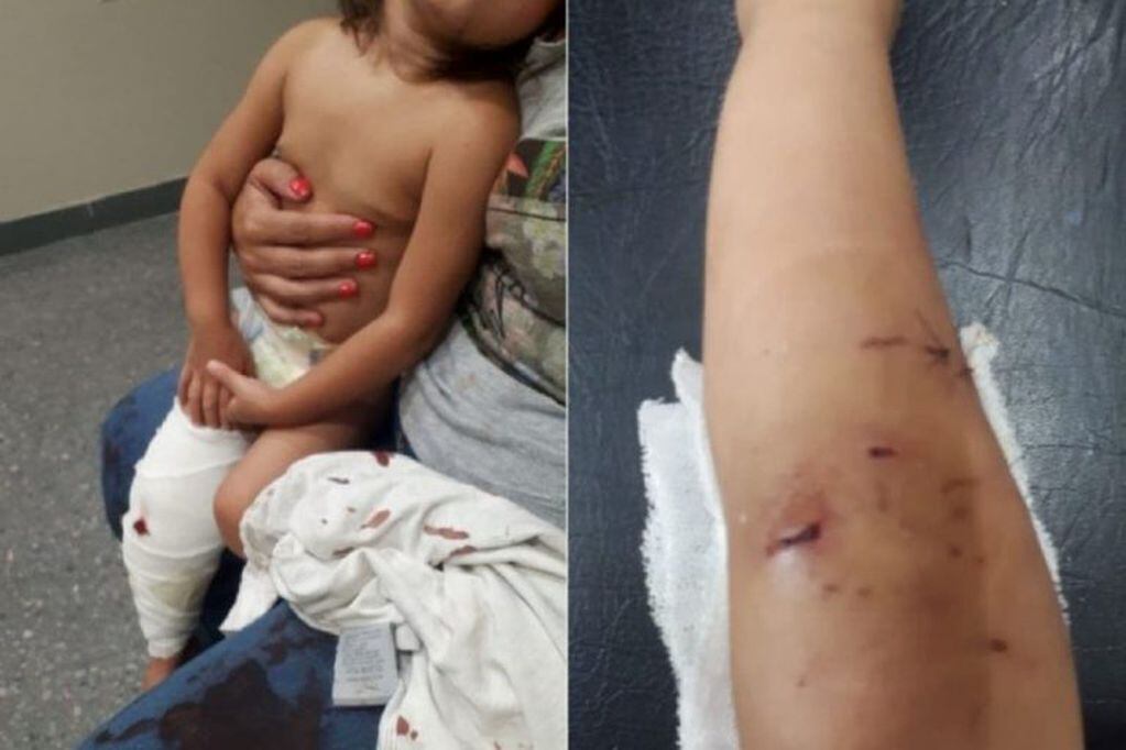 Un pitbull atacó a una nena de 2 años en Berisso (Berisso Ciudad)