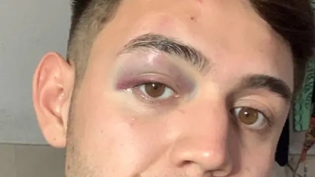 Joven golpeado en un boliche de Carlos Paz