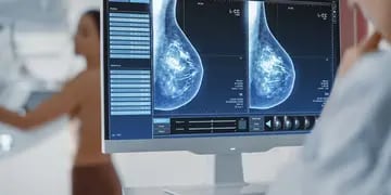 Mamografía cáncer de mama