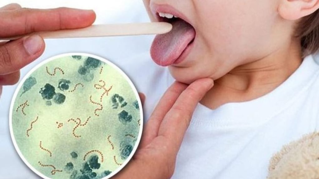 Ya fallecieron 17 personas por el Streptococcus pyogenes