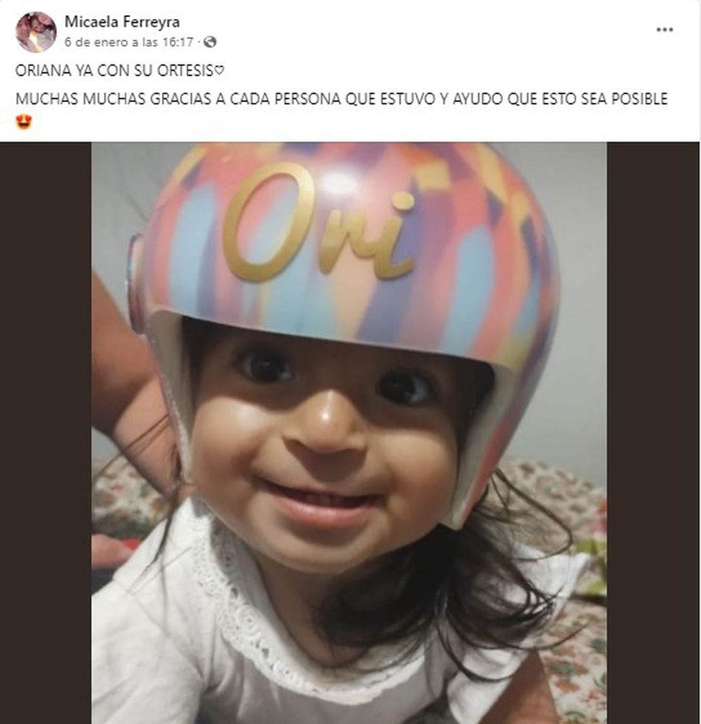 Oriana, la beba de San Luis que padece plagiocefalia, con su nuevo casco ortopédico.