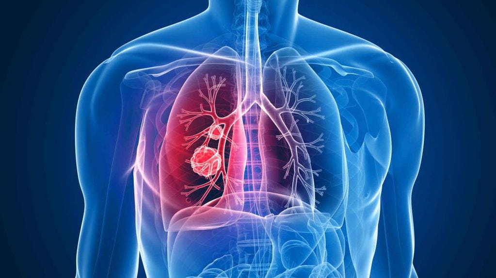 De acuerdo con la OMS, el cáncer de pulmón es una de las principales causas de muerte en todo el mundo.
