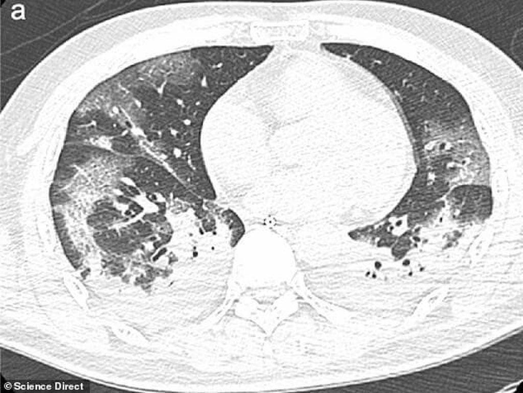 Los pulmones del paciente, cinco días más tarde, muestran progresión severa del cuadro de neumonía (credito: International Journal of Infectious Diseases).