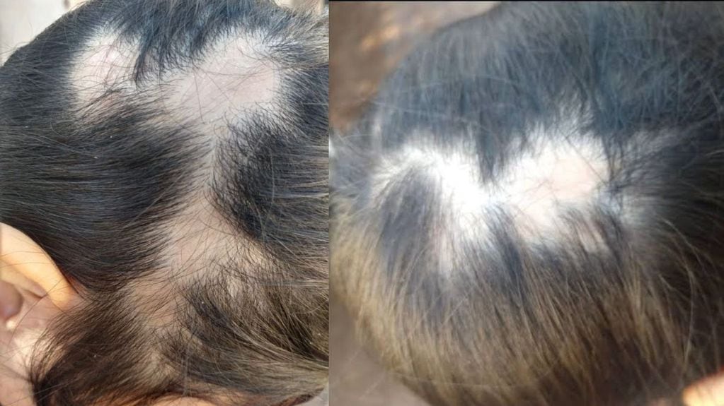 La depresión desembocó en alopecia y gastritis nerviosa, según contó la joven.