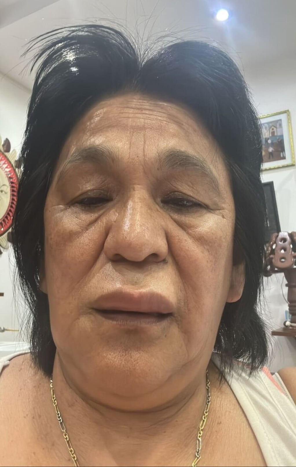 Allegados a Milagro Sala compartieron días pasados una fotografía de la dirigente, que evidenciaba los efectos del cuadro de trombosis en su organismo.
