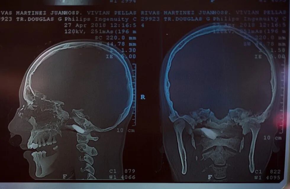 Un hombre sufrió un balazo en el cráneo durante un tiroteo. (Imagen ilustrativa)