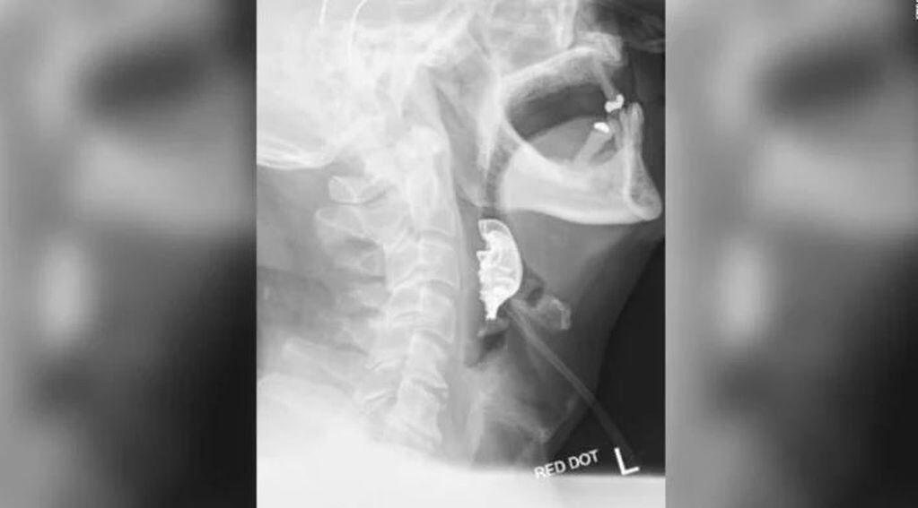 Un hombre tuvo la dentadura postiza atorada ocho días en la garganta tras una operación (Foto: web)