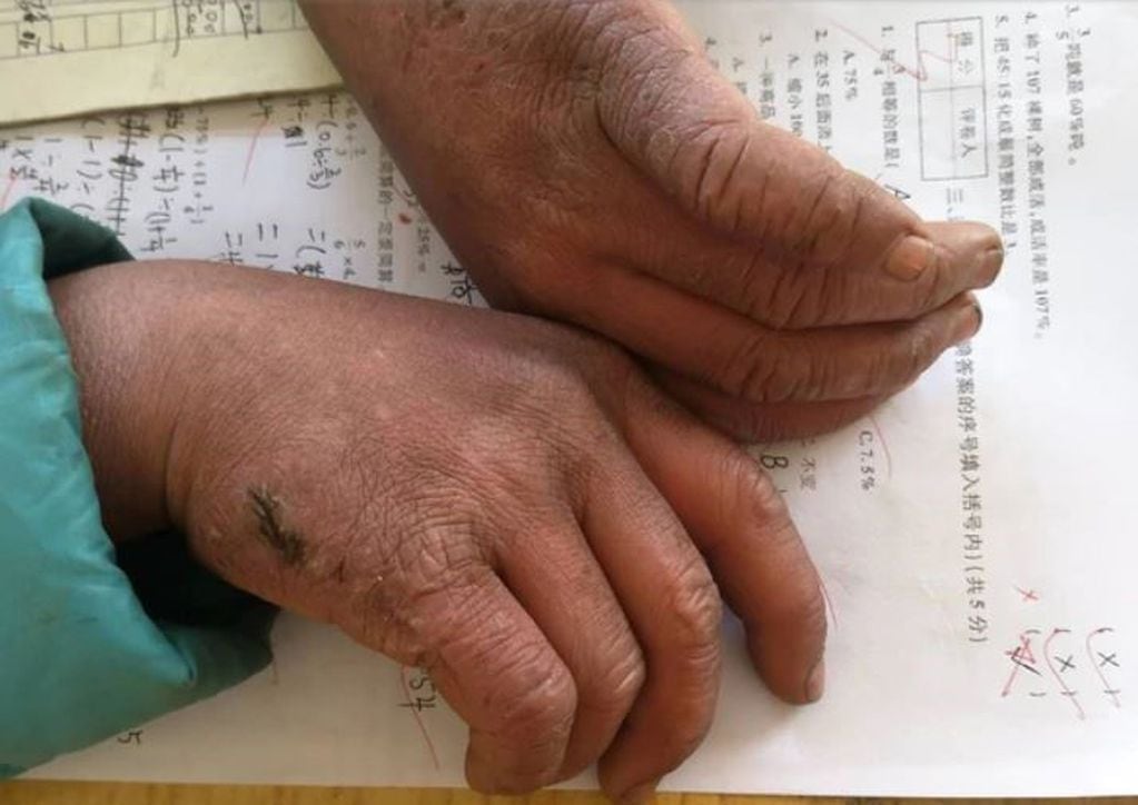 Las manos congeladas de Wang Manfu, el niño chino que se hizo viral.