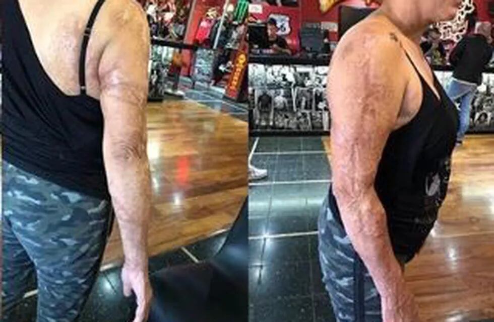 Vio a una mujer con los dos brazos quemados y le ofreció hacerle un tatuaje: el resultado es increíble