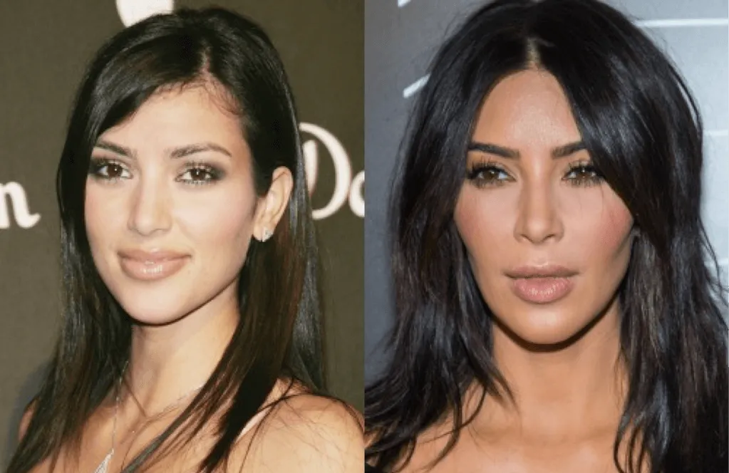 Kim Kardashian es una de las famosas de las que más se señala que se hizo la bichectomía.