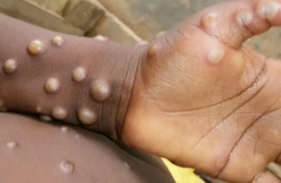 Las lesiones cutáneas producidas por la viruela del mono son uno de los muchos síntomas.
