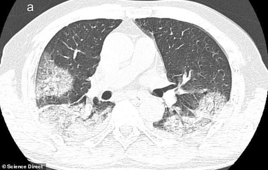 La radiografía del paciente masculino (credito: International Journal of Infectious Diseases).
