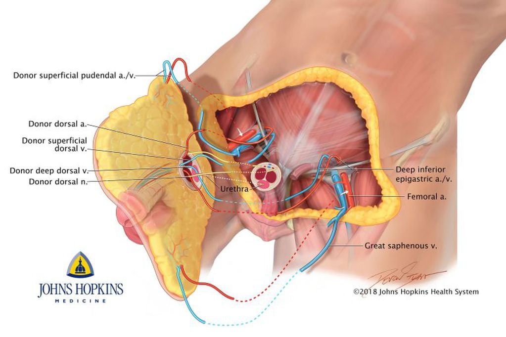 Fotografía cedida que muestra un dibujo del primer trasplante de pene y escroto realizado por la Facultad de Medicina de la Universidad Johns Hopkins con sede en Baltimore (Maryland).  EFE/Devon Stuart/Johns Hopkins Medicine/
