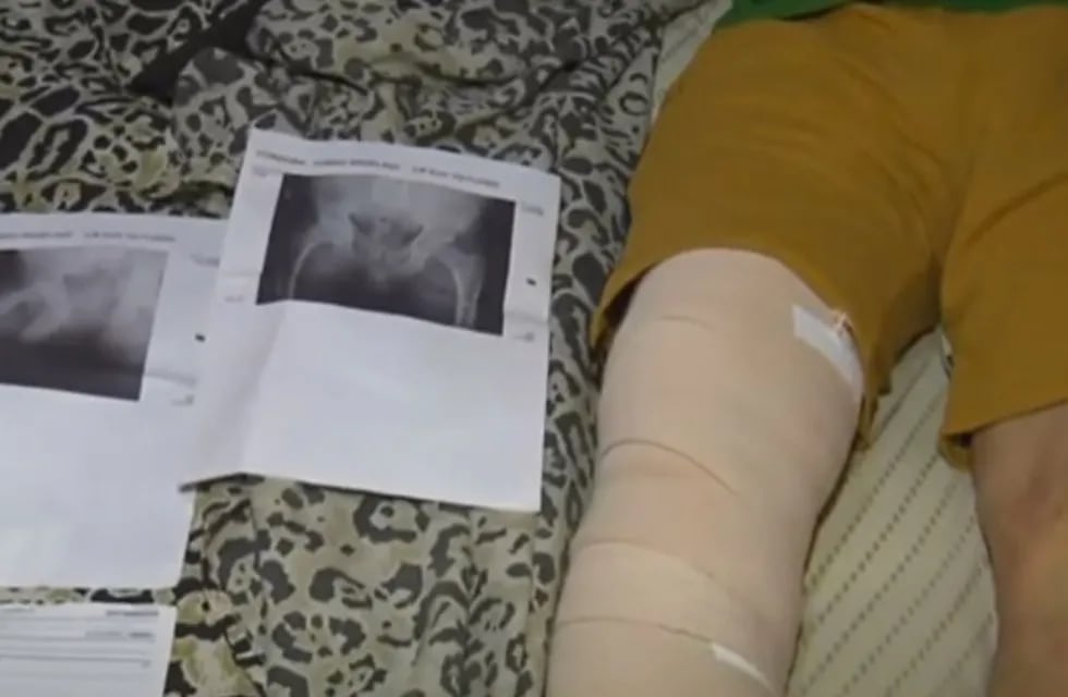 Tomás Córdoba asegura que fue víctima de una confusión, había otro paciente con el mismo apellido al que le tenían que poner una prótesis de rodilla.