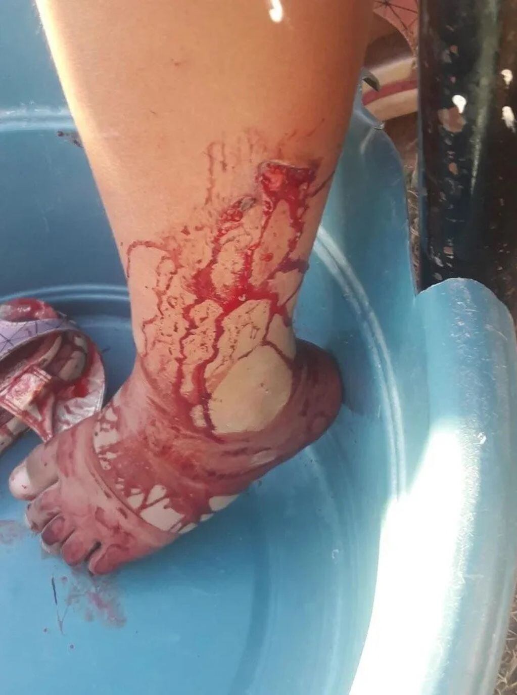 Así quedó la pierna de la niña de 8 años tras ser atacada por un pitbull. Diario de Cuyo.