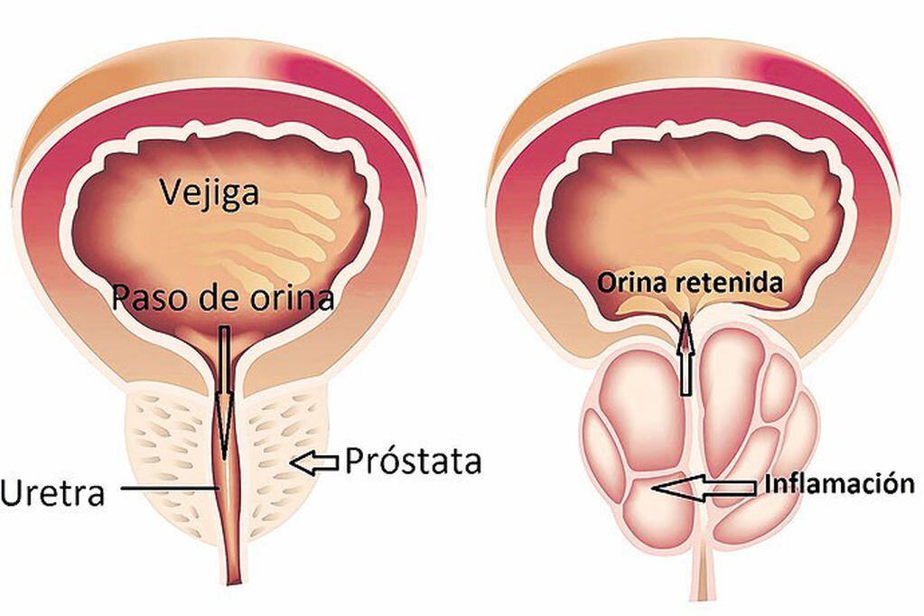 Síntomas en Cáncer de Próstata