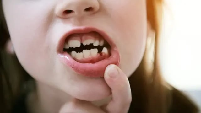 niña 81 dientes