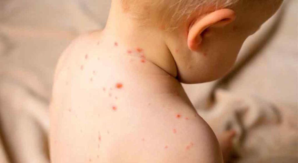 El sarampión es muy contagioso y afecta principalmente a niños. 