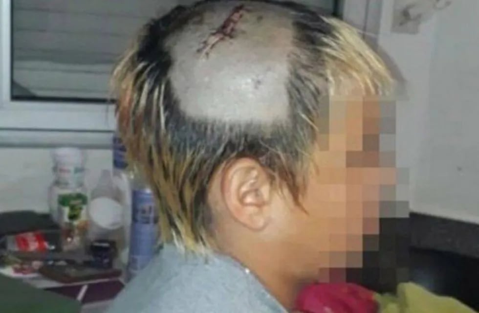 Imputaron a policías por fracturarle el cráneo a un chico de 10 años