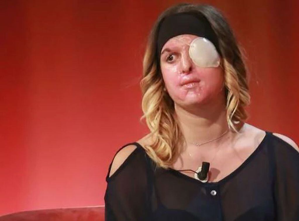 Una Modelo Italiana Que Fue Desfigurada Con ácido Por Su Ex Novio Mostró Su Cara