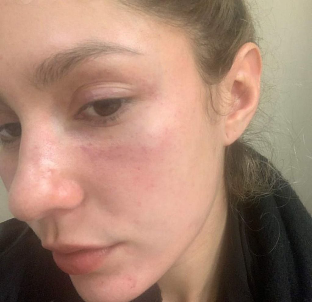 Las marcas de los golpes en el rostro de Camila (Foto: Instagram)