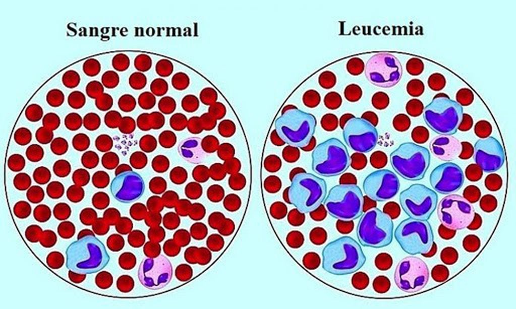 Muestras de sangre donde se diferencia la afección. 
La Leucemia Mieloide produce  glóbulos blancos anómalos en exceso llamados mieloblastos y estos alteran el funcionamiento normal de las céluas sanguíneas sanas.