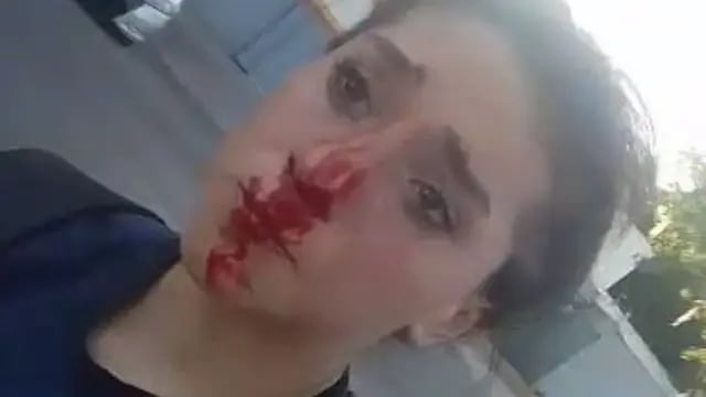 Martina Vallejos, de 13 años, con la nariz ensangrentada por un golpe.