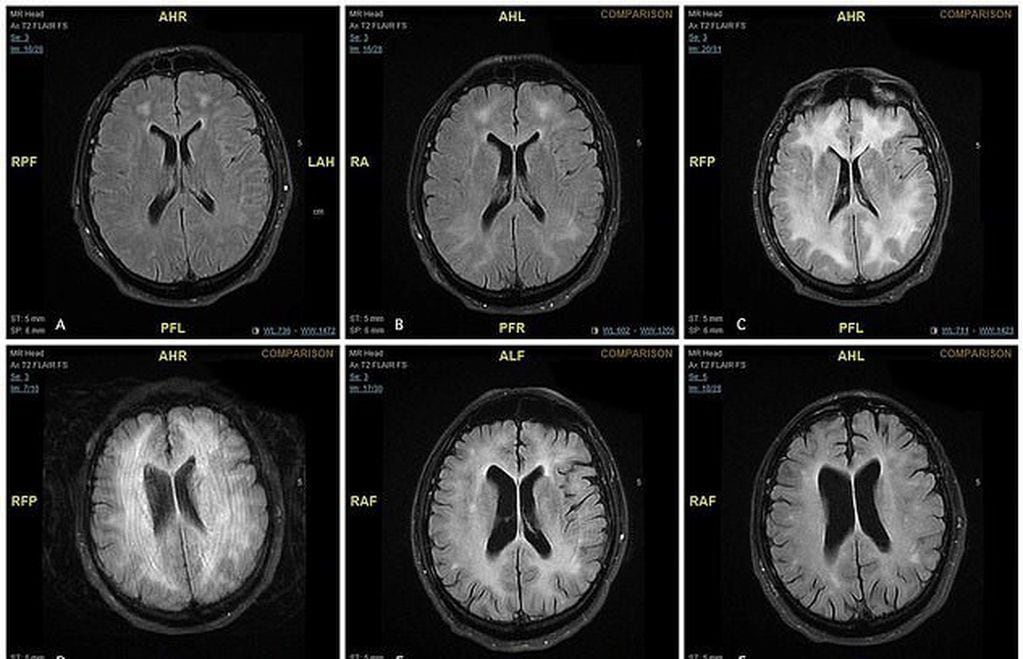 Las imágenes del cerebro afectado por cocaína, en el lapso de un año (Foto: BMJ).