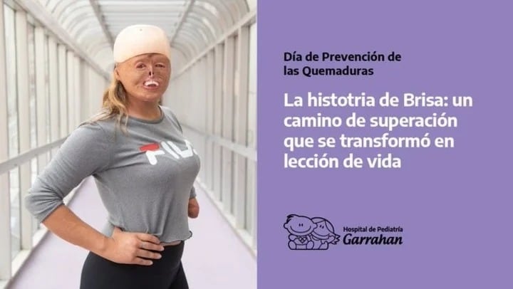 Brisa: la salteña que a los 7 meses se quemó el 90% de su cuerpo