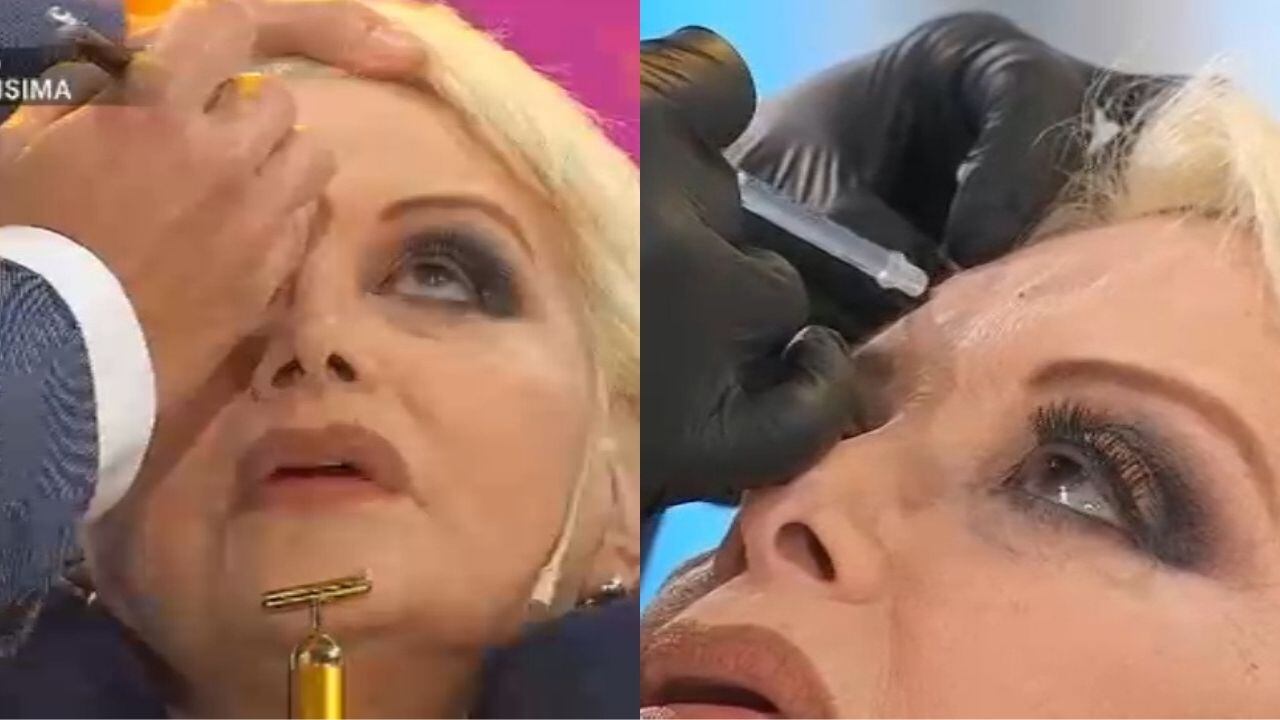 El día que Carmen Barbieri se puso bótox en vivo.