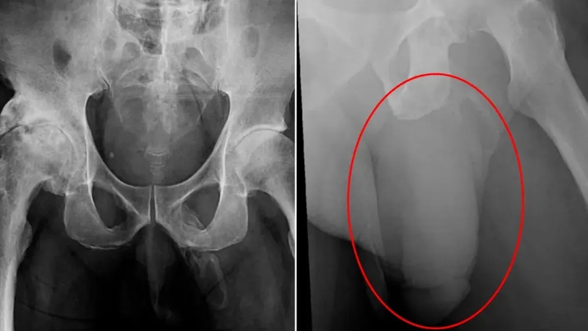 La radiografía que mostró el problema de un neoyorquino.