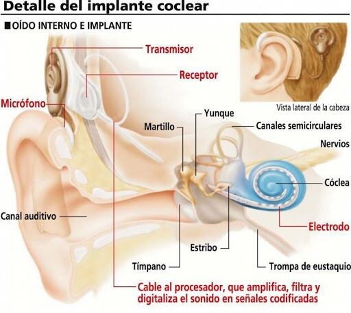 Implante coclear