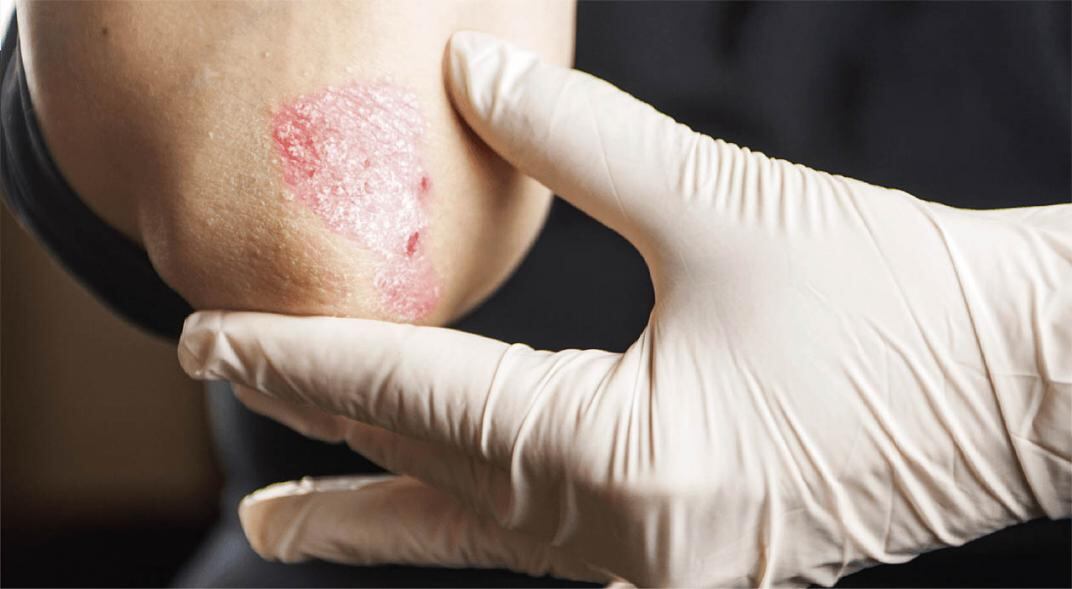 La psoriasis no es una enfermedad contagiosa.