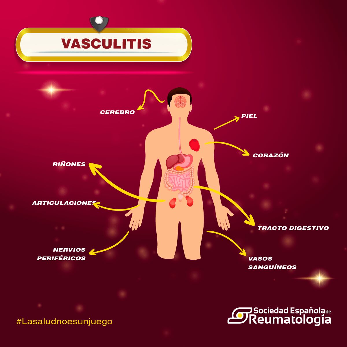 Vasculitis