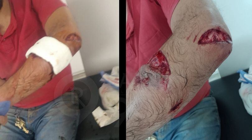 Heridas provocadas por un Pitbull