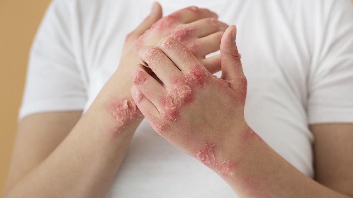 Psoriasis: qué es y cómo se diagnostica esta enfermedad.