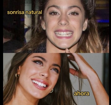 El antes y después en la sonrisa de Tini Stoessel