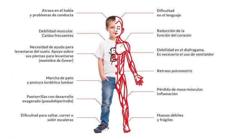 Distrofia Muscular de Duchenne