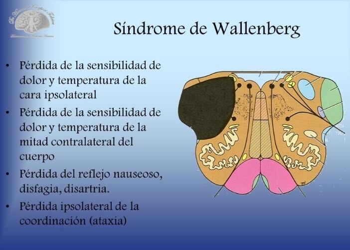 En qué consiste el Síndrome de Wallenberg.