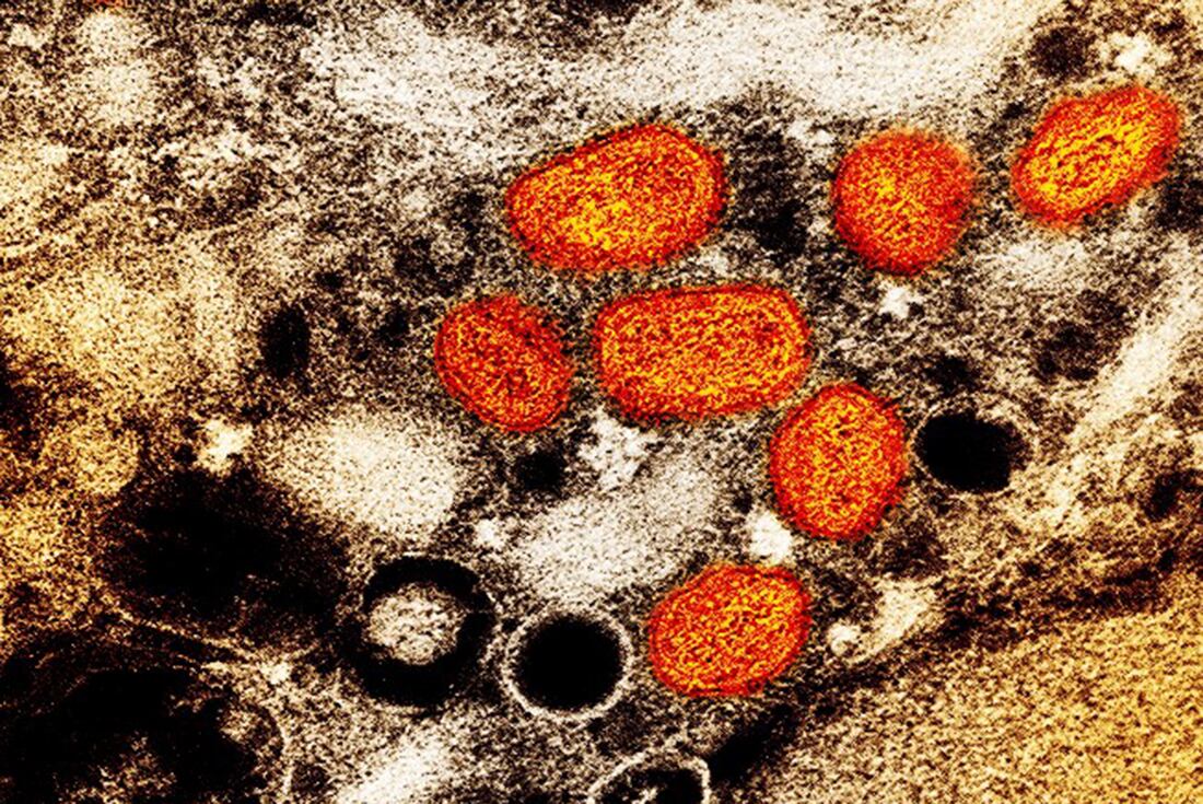 Esta imagen proporcionada por el Instituto Nacional de Alergias y Enfermedades Infecciosas (NIAID, por sus siglas en inglés) muestra una micrografía electrónica de transmisión coloreada de partículas de viruela del simio (naranja) encontradas dentro de una célula infectada (marrón), cultivadas en el laboratorio. (AP)