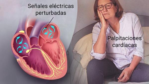 La fibrilación auricular. (WEB)