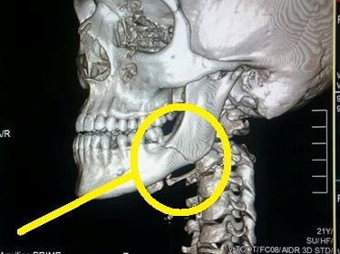 Imagen muestra fractura de mandíbula en la víctima