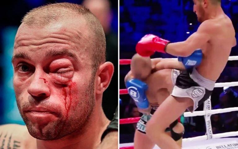 El rostro de un luchador de MMA tras recibir un rodillazo (Foto: Bellator Kickboxing)