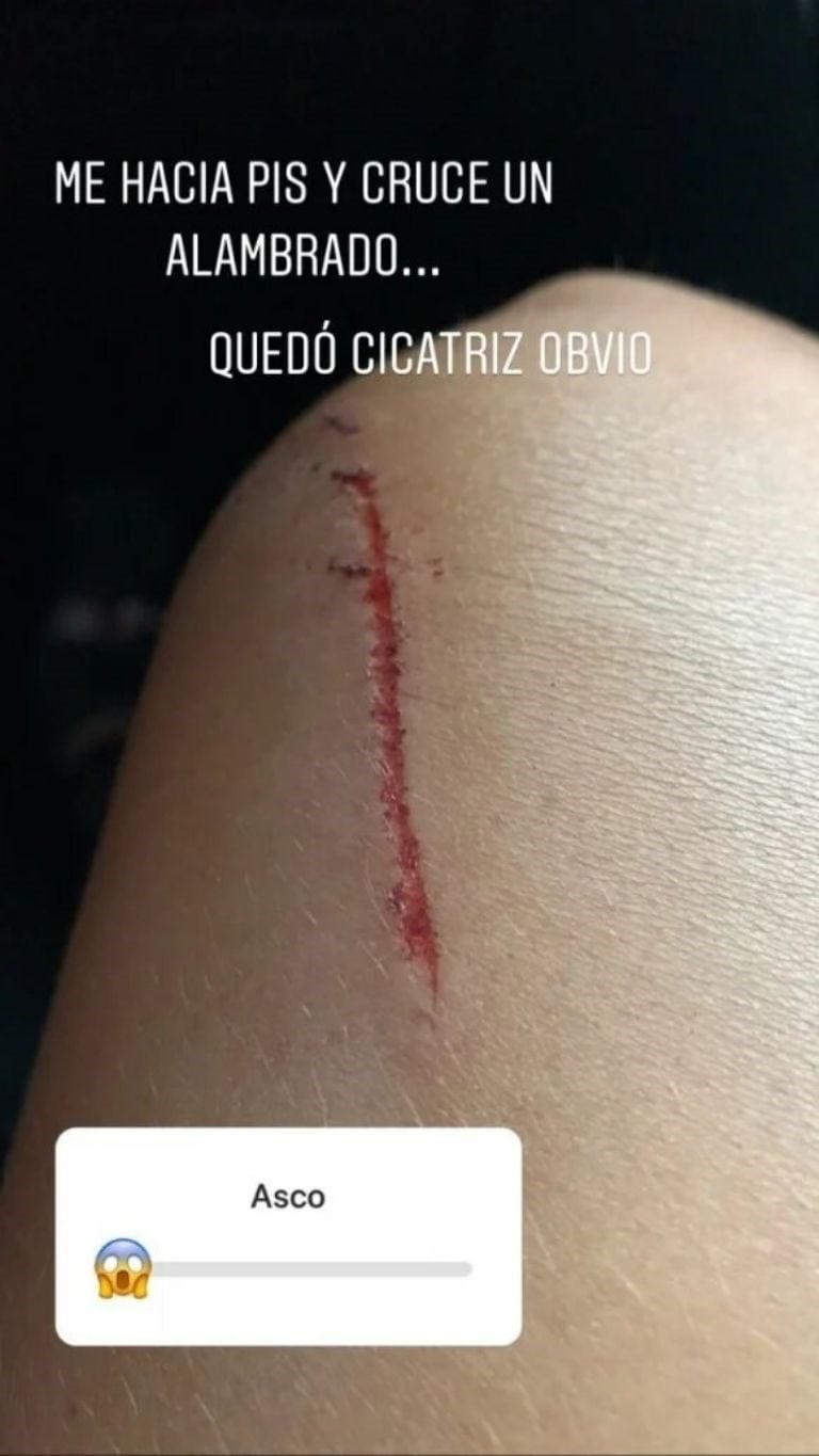 "Me hacía pis y crucé un alambrado. Quedó cicatriz, obvio", escribió en su última publicación.