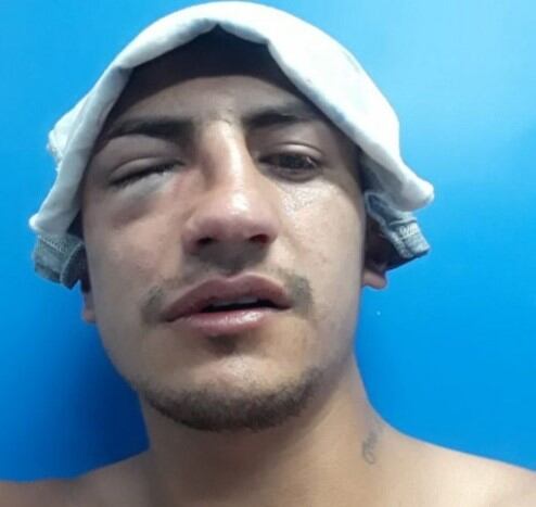 De esta forma quedó el rostro del jugador de UNCuyo, Brian Giménez.