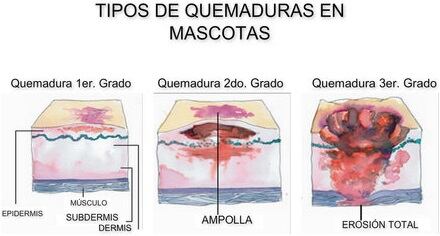 Tipos de quemadura