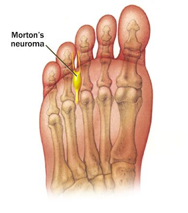 Neuroma de Morton