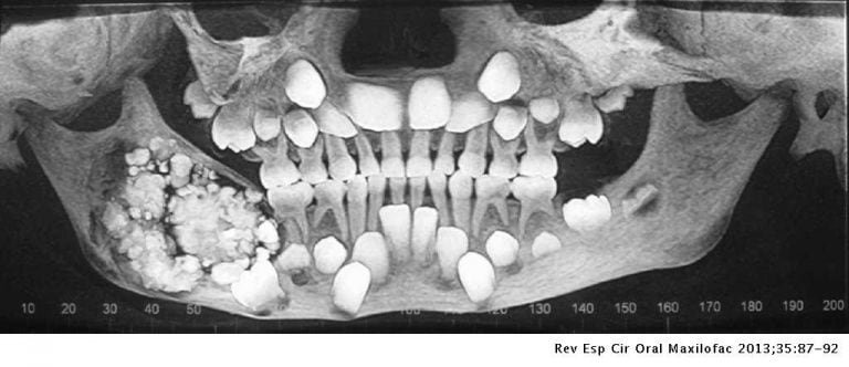 Odontoma (Foto: Elsevier).