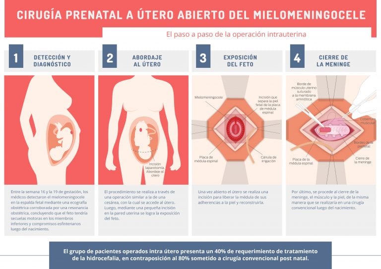 Operación a útero abierto. (Fuente: Hospital Italiano).