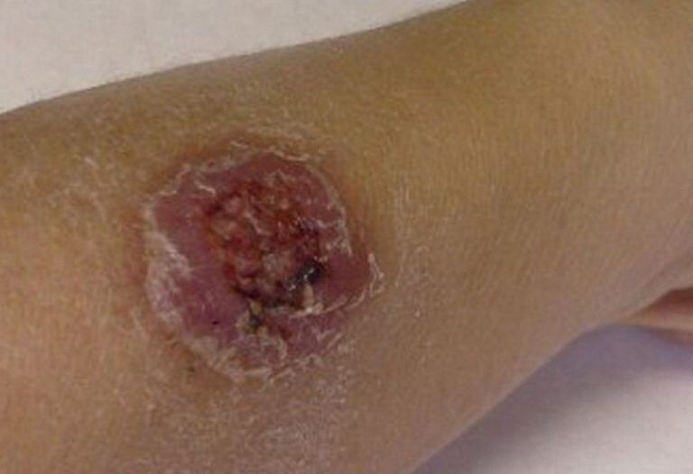 Confirman cuatro casos de leishmaniasis